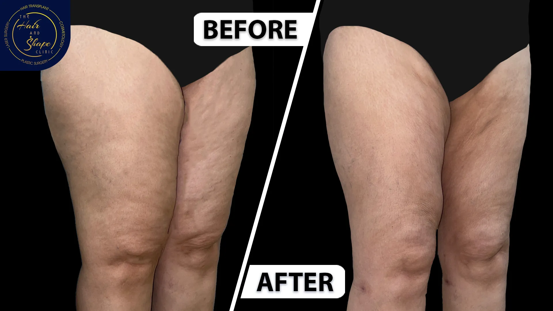 Thigh Liposuction result